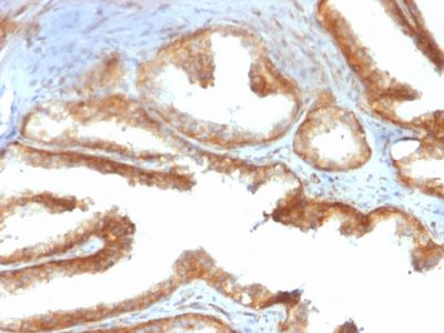 Formalin-fixed, paraffin-embedded human Prostate Carcinoma stained with YBX1 Mouse Recombinant Monoclonal Antibody (rYBX1/2430).