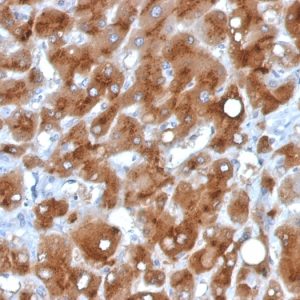 Formalin-fixed, paraffin-embedded human Hepatocellular Carcinoma stained with Serum Amyloid A Mouse Monoclonal Antibody (SAA/326).