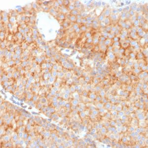 Formalin-fixed, paraffin-embedded human Urothelial Carcinoma stained with PAI-RBP1 Mouse Monoclonal Antibody (SERBP1/3491).