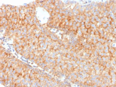 Formalin-fixed, paraffin-embedded human Urothelial Carcinoma stained with PAI-RBP1 Mouse Monoclonal Antibody (SERBP1/3491).