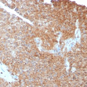 Formalin-fixed, paraffin-embedded human Urothelial Carcinoma stained with PAI-RBP1 Mouse Monoclonal Antibody (SERBP1/3493).