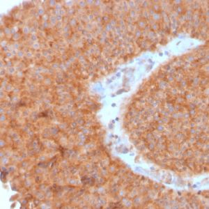 Formalin-fixed, paraffin-embedded human Urothelial Carcinoma stained with PAI-RBP1 Mouse Monoclonal Antibody (SERBP1/3495).