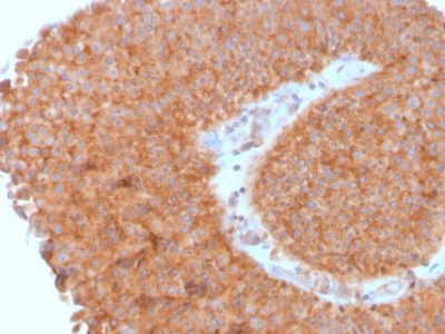 Formalin-fixed, paraffin-embedded human Urothelial Carcinoma stained with PAI-RBP1 Mouse Monoclonal Antibody (SERBP1/3495).