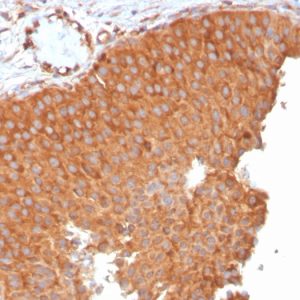 Formalin-fixed, paraffin-embedded human Urothelial Carcinoma stained with PAI-RBP1 Mouse Monoclonal Antibody (SERBP1/3496).