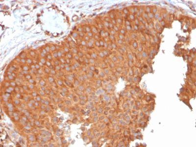 Formalin-fixed, paraffin-embedded human Urothelial Carcinoma stained with PAI-RBP1 Mouse Monoclonal Antibody (SERBP1/3496).