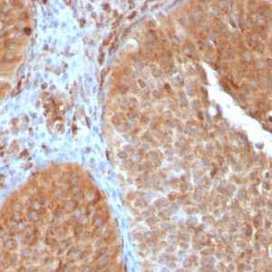 Formalin-fixed, paraffin-embedded human Urothelial Carcinoma stained with PAI-RBP1 Mouse Monoclonal Antibody (SERBP1/3497).