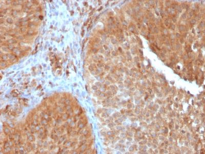 Formalin-fixed, paraffin-embedded human Urothelial Carcinoma stained with PAI-RBP1 Mouse Monoclonal Antibody (SERBP1/3497).