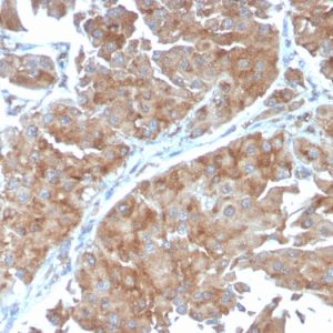 Formalin-fixed, paraffin-embedded human Urothelial Carcinoma stained with PAI-RBP1 Mouse Monoclonal Antibody (SERBP1/3498).