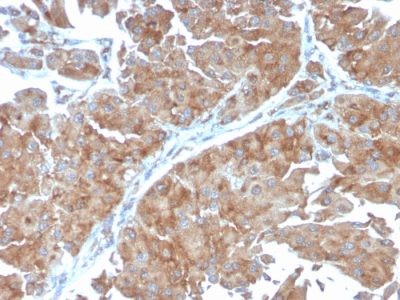 Formalin-fixed, paraffin-embedded human Urothelial Carcinoma stained with PAI-RBP1 Mouse Monoclonal Antibody (SERBP1/3498).