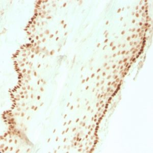 Formalin-fixed, paraffin-embedded human cervical carcinoma stained with SOX2 Recombinant Rabbit Monoclonal Antibody (SOX2/3811R).