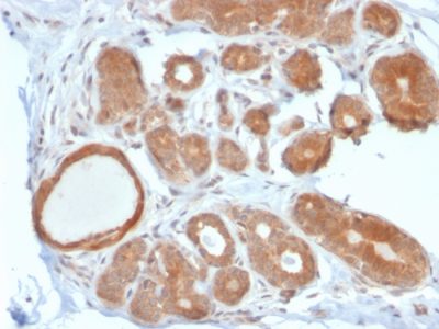 Formalin-fixed, paraffin-embedded human Breast Carcinoma stained with STAT5B Mouse Monoclonal Antibody (STAT5B/2611).