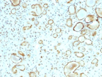 Formalin-fixed, paraffin-embedded human Renal Cell Carcinoma stained with STAT6 Mouse Monoclonal Antibody (STAT6/2410).