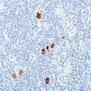 Formalin-fixed, paraffin-embedded human Hodgkin's Lymphoma stained with EBV Mouse Monoclonal Antibody (CS1-4).