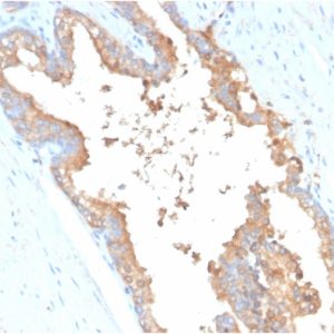 Formalin-fixed, paraffin-embedded human Prostate Carcinoma stained with Transferrin Mouse Monoclonal Antibody (TF/3001).
