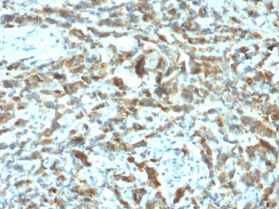 Formalin-fixed, paraffin-embedded human Breast Carcinoma stained with TFF1/pS2 Mouse Monoclonal Antibody (TFF1/2133).