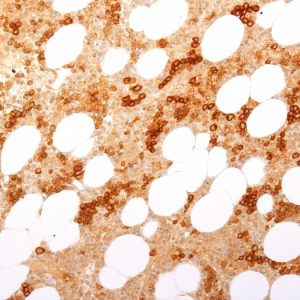 Formalin-fixed, paraffin-embedded Human Bone Marrow stained with CD71 Rabbit Recombinant Monoclonal Antibody (TFRC/2898R).