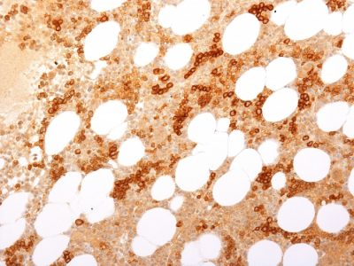 Formalin-fixed, paraffin-embedded Human Bone Marrow stained with CD71 Rabbit Recombinant Monoclonal Antibody (TFRC/2898R).