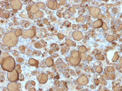 Formalin-fixed, paraffin-embedded human Thyroid Carcinoma stained with Thyroglobulin Rabbit Recombinant Monoclonal Antibody (TGB/1968R).