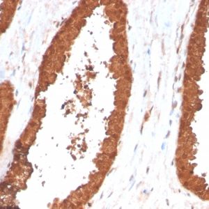 Formalin-fixed, paraffin-embedded human Prostate Carcinoma stained with TIGIT-Monospecific Mouse Monoclonal Antibody (TIGIT/3017).