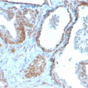 Formalin-fixed, paraffin-embedded human Prostate Carcinoma stained with TIGIT-Monospecific Mouse Monoclonal Antibody (TIGIT/3106).