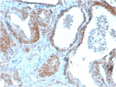 Formalin-fixed, paraffin-embedded human Prostate Carcinoma stained with TIGIT-Monospecific Mouse Monoclonal Antibody (TIGIT/3106).