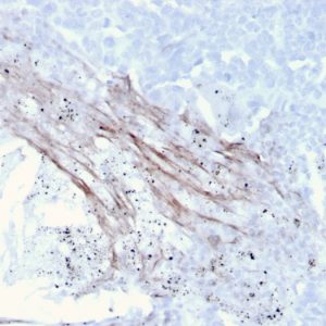 Formalin-fixed, paraffin-embedded human Lung Carcinoma stained with Tenascin C Mouse Recombinant Monoclonal Antibody (TNC/3635).