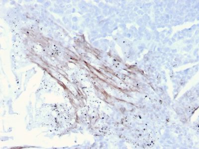 Formalin-fixed, paraffin-embedded human Lung Carcinoma stained with Tenascin C Mouse Recombinant Monoclonal Antibody (TNC/3635).