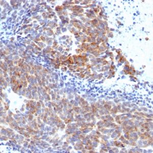 Formalin-fixed, paraffin-embedded human Melanoma stained with Topo I, MT Mouse Monoclonal Antibody (TOP1MT/568).