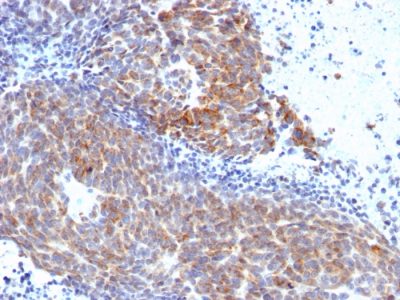 Formalin-fixed, paraffin-embedded human Melanoma stained with Topo I, MT Mouse Monoclonal Antibody (TOP1MT/568).