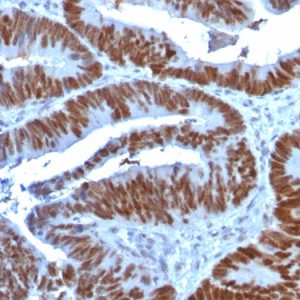 Formalin-fixed, paraffin-embedded human Colon Carcinoma stained with p53 Mouse Monoclonal Antibody (TP53/1739).