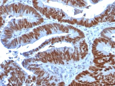 Formalin-fixed, paraffin-embedded human Colon Carcinoma stained with p53 Mouse Monoclonal Antibody (TP53/1739).