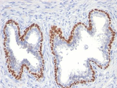 Formalin-fixed, paraffin-embedded human Prostate Cancer stained with p63 Mouse Monoclonal Antibody (TP63/11).