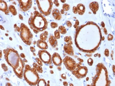 Formalin-fixed, paraffin-embedded human Thyroid Carcinoma stained with Thyroid Peroxidase Mouse Monoclonal Antibody (TPO/1921).