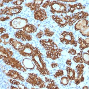Formalin-fixed, paraffin-embedded human Thyroid Carcinoma stained with Thyroid Peroxidase Mouse Monoclonal Antibody (TPO/1922).