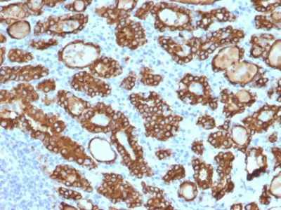 Formalin-fixed, paraffin-embedded human Thyroid Carcinoma stained with Thyroid Peroxidase Mouse Monoclonal Antibody (TPO/1922).