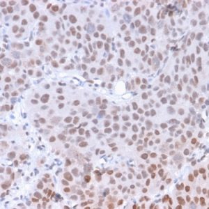 Formalin-fixed, paraffin-embedded human Colon Carcinoma stained with RNA Polymerase II / Poll II Mouse Monoclonal Antibody (8A7).