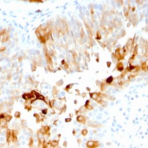Formalin-fixed, paraffin-embedded human Urothelial Carcinoma stained with Uroplakin 1A Mouse Monoclonal Antibody (UPK1A/2921).