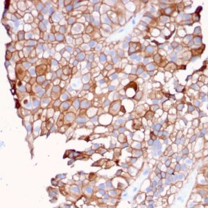 Formalin-fixed, paraffin-embedded human Urothelial Carcinoma stained with Uroplakin 1B Mouse Monoclonal Antibody (UPK1B/3081).