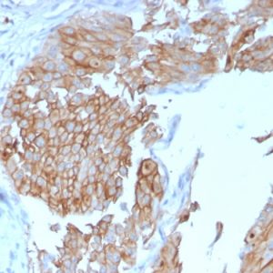 Formalin-fixed, paraffin-embedded human Urothelial Carcinoma stained with Uroplakin 1B Mouse Monoclonal Antibody (UPK1B/3102).