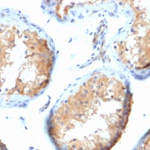 Formalin-fixed, paraffin-embedded human Testicular Carcinoma stained with Vinculin Mouse Monoclonal Antibody (VCL/2573).
