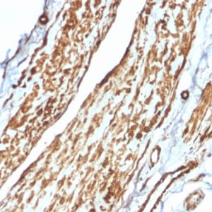 Formalin-fixed, paraffin-embedded human Testicular Carcinoma stained with VCL Mouse Monoclonal Antibody (VCL/2575).
