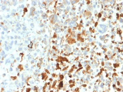 Formalin-fixed, paraffin-embedded human Melanoma stained with Vimentin Rabbit Recombinant Monoclonal Antibody (VIM/1937R).
