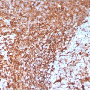 Formalin-fixed, paraffin-embedded human Prostate Carcinoma stained with Vimentin Mouse Monoclonal Antibody (VIM/3736).