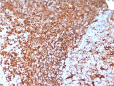 Formalin-fixed, paraffin-embedded human Prostate Carcinoma stained with Vimentin Mouse Monoclonal Antibody (VIM/3736).