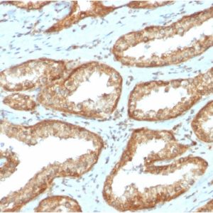 Formalin-fixed, paraffin-embedded human Prostate Carcinoma stained with YBX1 Mouse Monoclonal Antibody (YBX1/2430)