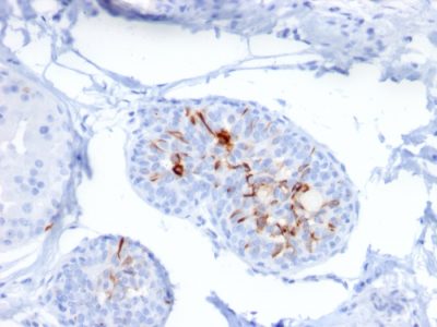 Formalin-fixed, paraffin-embedded human Breast Carcinoma stained with ZNF690 / ZSCAN29 Mouse Monoclonal Antibody (ZSCAN29/2610).