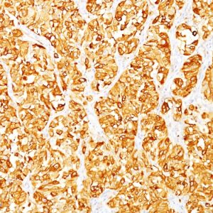Formalin-fixed, paraffin-embedded human Melanoma stained with Melan-A / MART-1 Mouse Monoclonal Antibody (DT101 + BC199).
